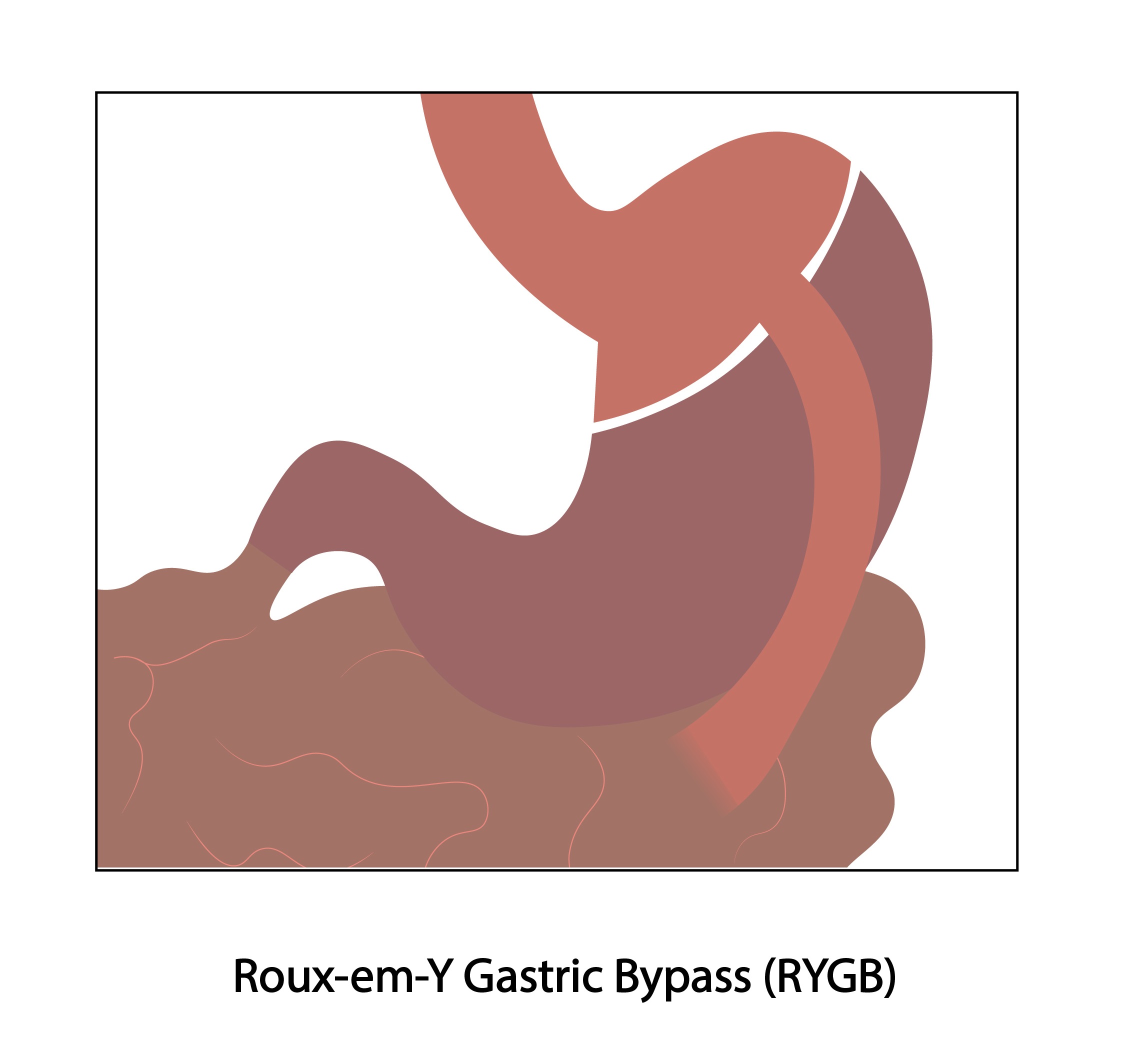 Gastric Bypass